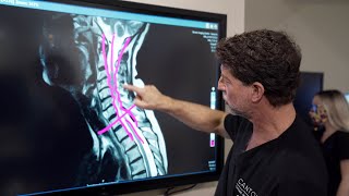 Symptoms of Cervical Stenosis  Jeffrey Cantor MD [upl. by Delilah]