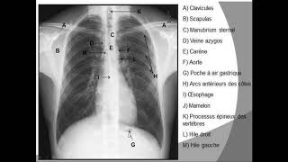 le visible et linvisible sur une radiographie thoracique [upl. by Ulla]