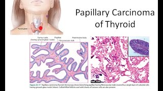 Pathology 818 a Papillary Carcinoma Thyroid Orphan Annie Eye Ground Lateral Aberrant psammoma bodies [upl. by Aselehc]