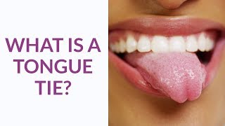 How tongue tie laser works [upl. by Sauncho]