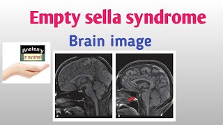 Empty sella syndrome No pituitary gland Anatomy in nutshell shorts [upl. by Eile]