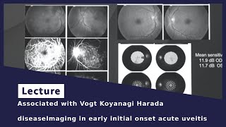 Associated with Vogt Koyanagi Harada diseaseImaging in early initial onset acute uveitis [upl. by Mala]