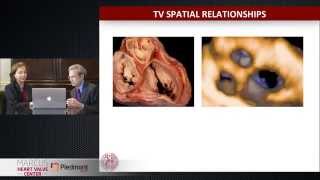 Echocardiographic Approach to the Tricuspid Valve 3D Echo 360 Conference [upl. by Eyssej]