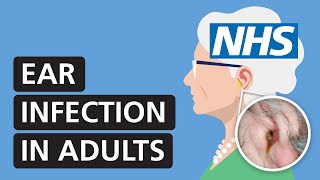 Ear infection in adults symptoms treatment and pain relief  NHS [upl. by Atika]