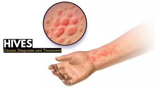 HIVES Causes Signs and Symptoms Diagnosis and Treatment [upl. by Cul]