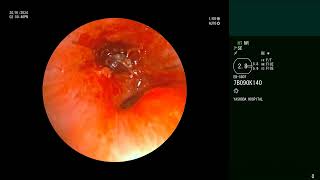 Airway Foreign Body  Whistle  Bronchoscopic retrievel [upl. by Malvia171]