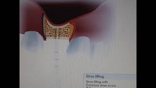 Sinus lift video using MISImplants Bone compression kit [upl. by Bennion]