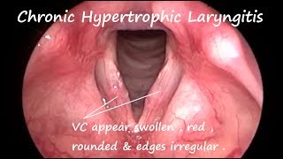 Laryngology  Chronic Hypertrophic Laryngitis [upl. by Kassaraba]