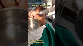 TMJ Arthrocentesis by Dr Hemant Baonerkar Maxillofacial Surgeon [upl. by Girard]