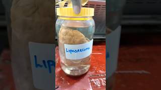 Grossing of liposarcoma specimen  histopathology Lipoma liposarcoma [upl. by Tacklind953]