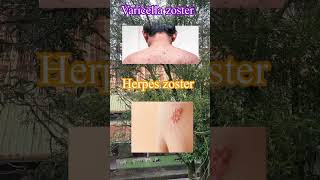 Perbedaan varicella zoster dan herpes zoster shorts herpeszoster varicellazoster penyakit [upl. by Okechuku]