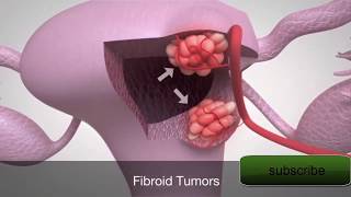 How Fibroids Are Treated  Fibroid Removal Surgery [upl. by Fancy]