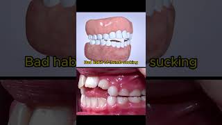 Causes of overbite teeth [upl. by Aikenahs477]