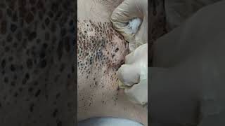 Nevus Comedonicus removal [upl. by Ynaffit668]