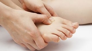 Gout causes Symptoms and Treatment How to prevent Gout [upl. by Innus42]