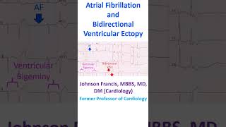 Atrial Fibrillation and Bidirectional Ventricular Ectopy [upl. by Notanhoj]