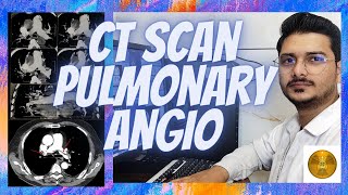 CT SCAN  Pulmonary angio filming process angiography pulmonary radiologytechnologist [upl. by Resiak]