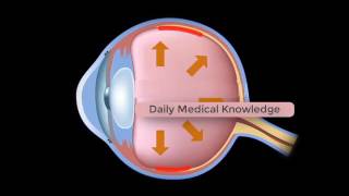 Development of Glaucoma Animation Open Angle vs Angle Closure Glaucoma [upl. by Koball]