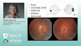 Papilledema  IIH NonIIH Approach to ON Edema [upl. by Arual980]