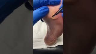 Watch this significant corn removal transformation by our expert podiatrist FootCare PodiatryMagic [upl. by Nosreg429]