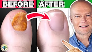 1 Absolute Best Toenail Fungus Cure [upl. by Beaufort]