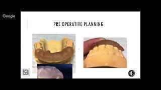 3D Endodontics in BSP [upl. by Dody]