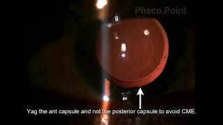 Post operative Capsular block syndrome  how to detect and treat [upl. by Fagaly317]