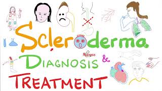 Scleroderma Diagnosis and Management [upl. by Enair]