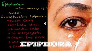 What is EpiphoraWatery Eye   Causes  examination  treatment [upl. by Peednam]