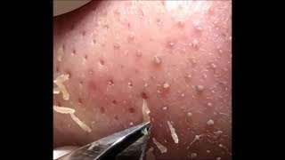 角栓 除去 blackheads removal 080 [upl. by Enilhtak811]