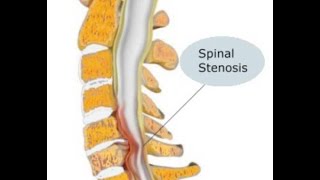 Estenosis Espinal [upl. by Ardnasela]