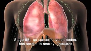 English MAKNA Getting to know Lung Cancer [upl. by Tami]