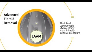 LAAM CIGC’s FastRecovery Laparoscopic Myomectomy [upl. by Khosrow]