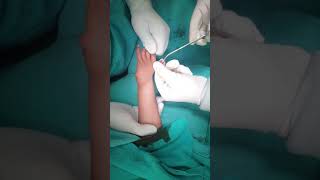 Hypoplastic Thumb and Camptodactyly in Radial Club Hand [upl. by Blader]