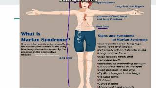 Marfan Syndrome [upl. by Sitoel]