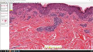 Erythema multiforme [upl. by Blumenfeld]