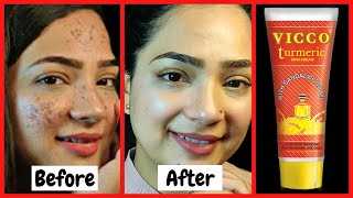 WORK FOR PIMPLES Vicco turmeric ayurvedic cream  Full reviewUsesbenefitsSide effects [upl. by Terena]