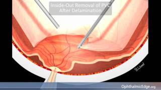 Diabetic Tractional Retinal Detachment [upl. by Orelia]