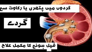 symptoms of kidney stones in urdu  professordrjavediqbal [upl. by Georgena]