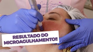 Resultados do Microagulhamento  Antes e Depois  Tratamento para Cicatriz de Acne [upl. by Boru975]