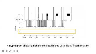 polysomnography report interpretation [upl. by Kellsie551]