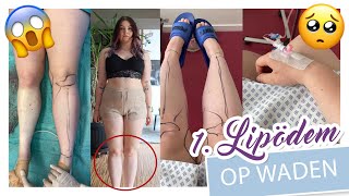 Meine 1 LIPÖDEM OPERATION  WADEN  Liposuktion Ergebnis Heilung Kosten etc  YooNessa [upl. by Emad]