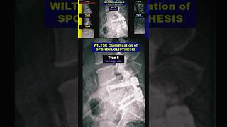 Spondylolisthesis  Wiltse Classification radiology bones spine xray [upl. by Missie]