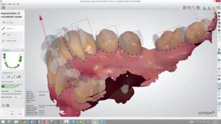 3Shape Ortho Analyzer  How to Segment Teeth [upl. by Smoht196]