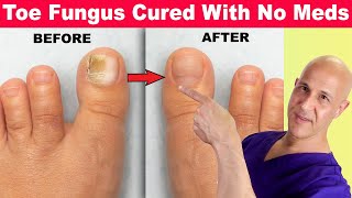 Toe Nail Fungus Cured With No Meds Dr Mandell [upl. by Stacia]