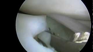 Knee Surgery Lateral Meniscus Surgery [upl. by Lehsar]