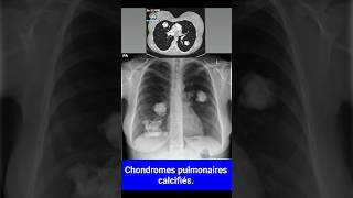 chest xray radiologiest radiographie thoracique diagnosticradiology doctor [upl. by Yasmeen]