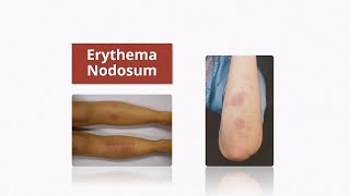 Erythema Nodosum  Causes amp Treatment [upl. by Fuhrman374]