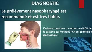 Coqueluche sur enfant de 4 ans symptômes  diagnostics  traitements [upl. by Niabi]