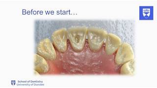 Endodontic treatment of the single rooted tooth Part 2 Access cavity preparation [upl. by Utham]